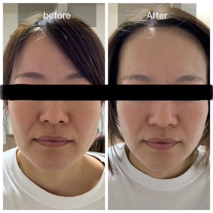 顔のたるみのビフォーアフター